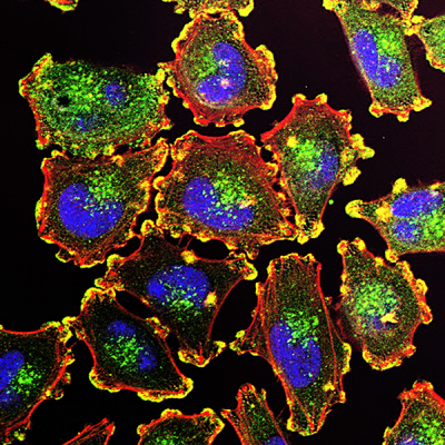 actin-rich podosomes (yellow) in melanoma cells