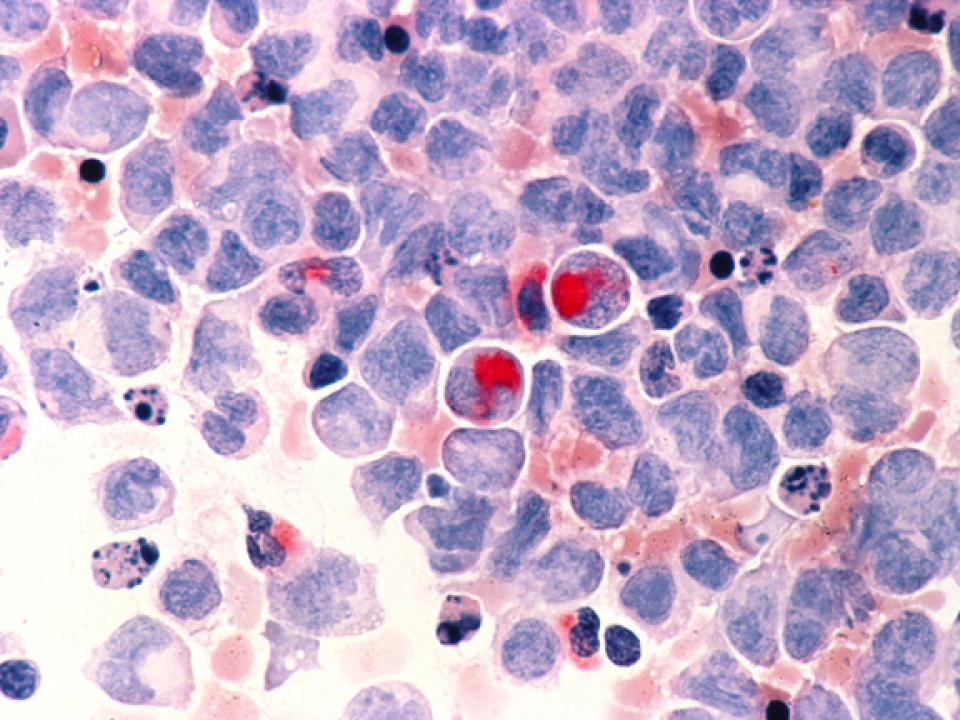 Leukemia (AML)