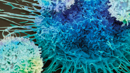 Scanning electron microscopy image of CAR T cells attacking a lung cancer cell
