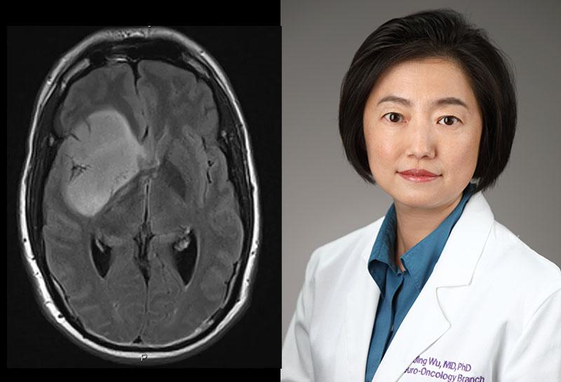 MRI scan of brain with tumor next to headshot of Jing Wu