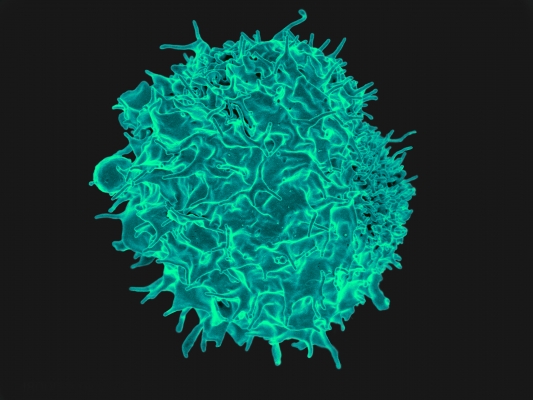 A colorized scanning electron micrograph of a T lymphocyte used in immunotherapy.