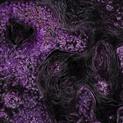 In this image from a genetically engineered mouse model, lung cancer driven by the KRAS oncogene shows up in purple.