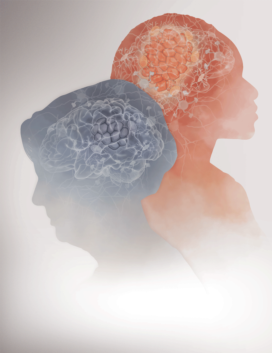 Why Age is an Advantage - Illustration of an older woman's head (left) and a younger woman's head (right) showing various states of metastasis in each brain