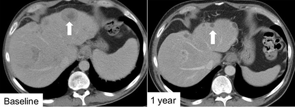 Clinical trial shows safety and effectiveness of new