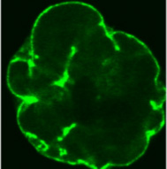 Tumor Protective Mechanism Identified From Premature Aging Disease