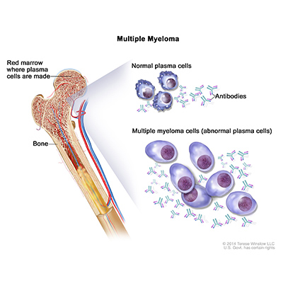 Majority Of Patients With Advanced Multiple Myeloma Respond To CAR T ...