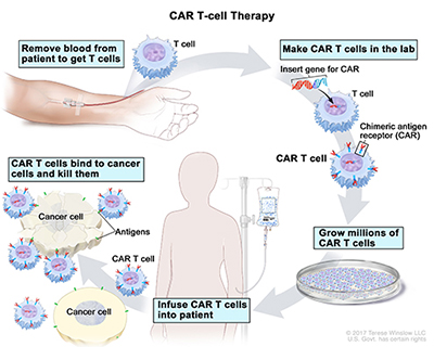 SLAMF7-CAR T cell treatment of Multiple Myeloma patients
