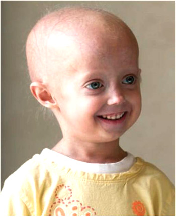 Unraveling the Mysteries of Progeria | Center for Cancer ...