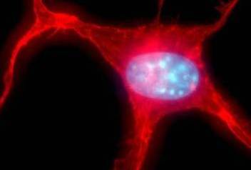 High-powered microscopic image of a tumor cell