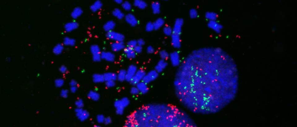 Lung cancer cells fluorescently labeled for MYC (red), MYCL (green) and chromosomes (blue) to identify MYC- and MYCL-positive ecDNA in the cells.