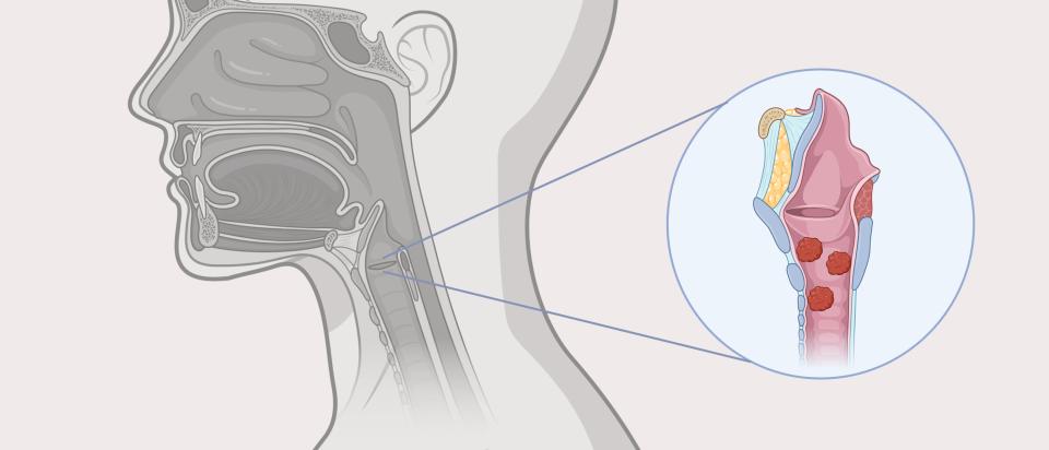 An illustration of papillomas in the throat