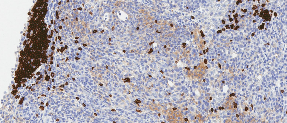 CD45R-stained IHC image depicting B cells within a tertiary lymphoid structure in a triple-treated cholangiocarcinoma tumor