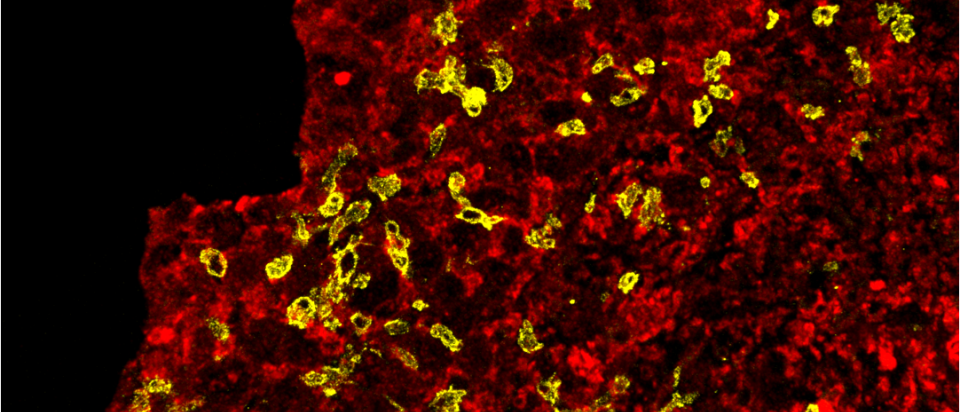 engineered natural killer cells (yellow) can expand in solid tumors and kill tumor cells (red)
