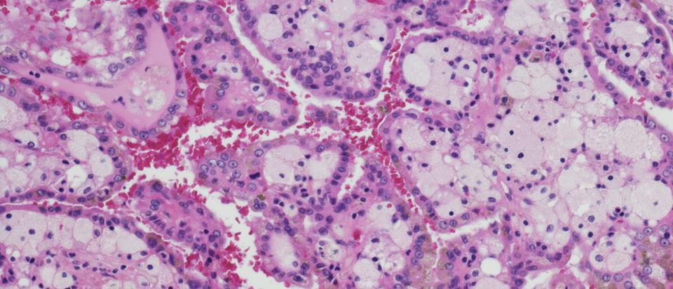 Micrograph of renal cell carcinoma. 