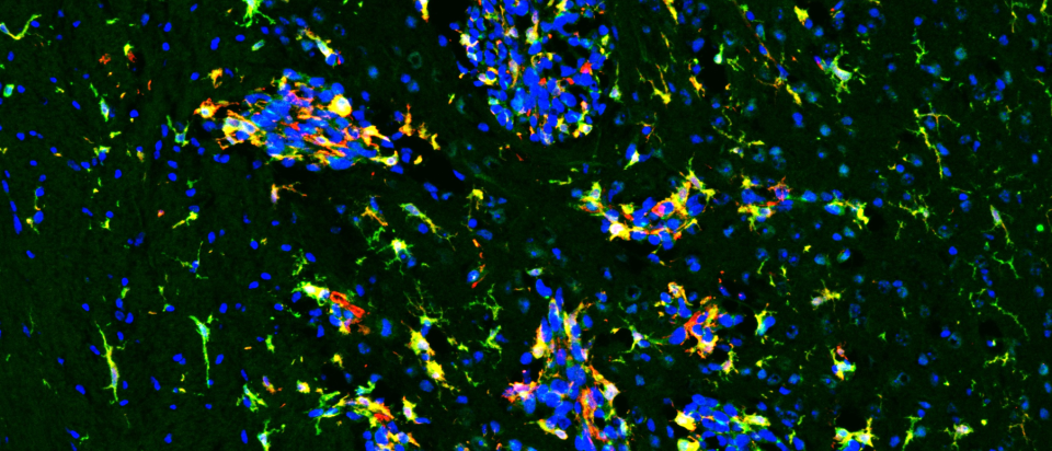 Fluorescent image showing the protein CSF-1R (green), microglia (red), and cell nuclei (blue) in a breast cancer brain metastasis model. Microglia cells near and inside the brain tumors are expressing the CSF-1R protein (yellow)