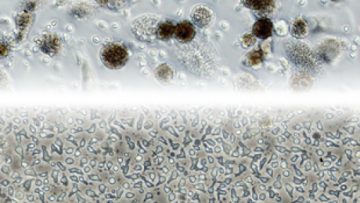Cells isolated from a tumor after removal