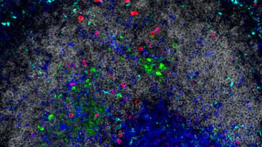 Mobilizing Patients’ Immune Systems to Target and Treat Brain and Spine Tumors 