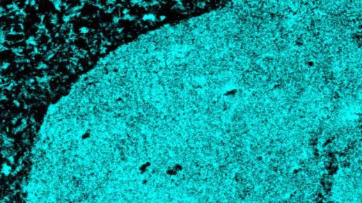 A microscopy image showing how an AI tool can identify tumor tissue (blue) vs. non-tumor tissue (black)