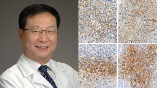 Zhengping Zhuang, microscopy images showing the prevalence of the protein CAIX in human glioblastoma cells