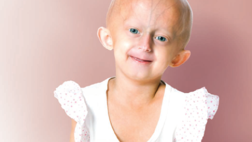 Young girl with progeria