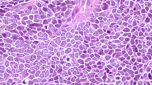 Merkel cell carcinoma tissue