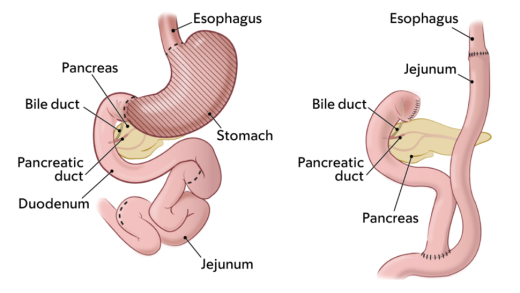 gastrectomy illustration