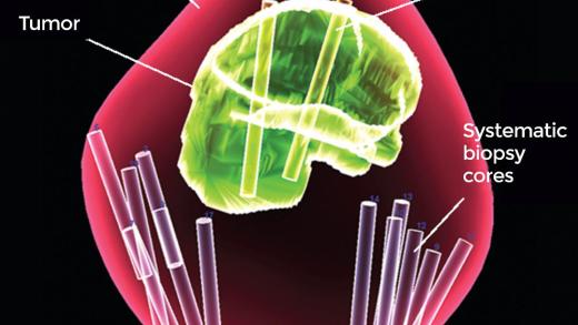 A 3-D map of the prostate using combined MRI-targeted and systematic biopsies.