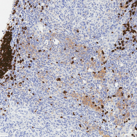 CD45R-stained IHC image depicting B cells within a tertiary lymphoid structure in a triple-treated cholangiocarcinoma tumor
