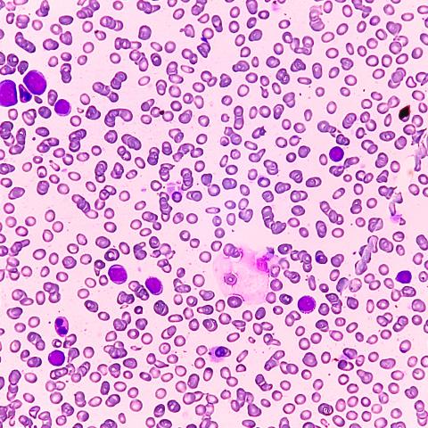 Acute myeloid leukemia. Image credit: iStock