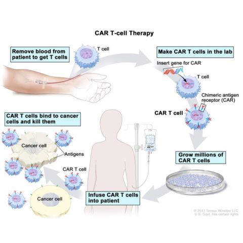 Kreitman trial CAR T cell therapy description