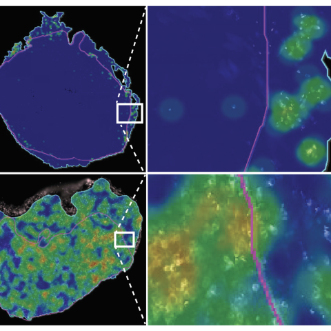 Spatial heatmap of CD3+ T cells in small cell lung cancer (SCLC) tumors. Top: Notch1 gene inactive, “cold” SCLC with T cells located on the tumor periphery (immune-excluded). Bottom: Notch1 gene active, “hot” SCLC with abundant T cell tumor infiltration (immune-inflamed).