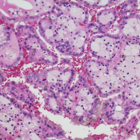 Micrograph of renal cell carcinoma.