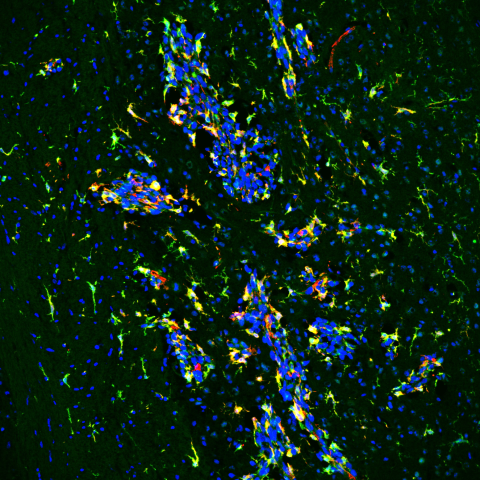 Fluorescent image showing the protein CSF-1R (green), microglia (red), and cell nuclei (blue) in a breast cancer brain metastasis model. Microglia cells near and inside the brain tumors are expressing the CSF-1R protein (yellow)