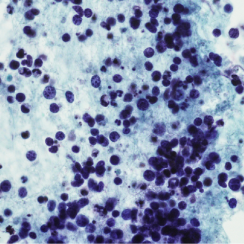 Micrograph of small cell carcinoma