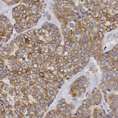 Microscopic view of a tissue sample of ductal cell carcinoma from human breast cancer. Image credit: Allan Weissman, M.D., Senior Investigator in the Cancer Innovation Laboratory at CCR, and Kevin Gardner, M.D., Ph.D., Professor of Pathology and Cell Biology at Columbia University.