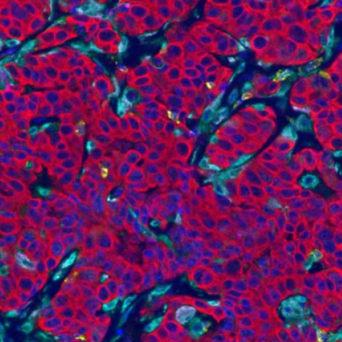 A collection of cancer cells surrounded by immune cells