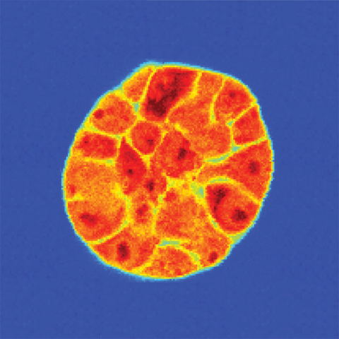 A spheroid of breast cancer cells grown in a three-dimensional matrix.