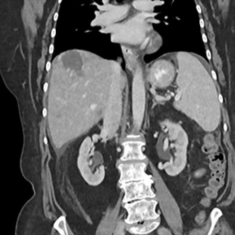 Bladder cancer scan