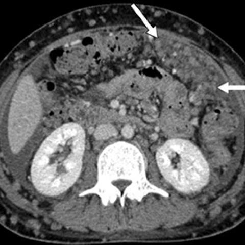 Peritoneal carcinomatosis
