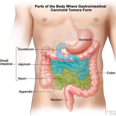 The middle portion of the gastrointestinal tract is a common location for cancerous neuroendocrine tumors to form.