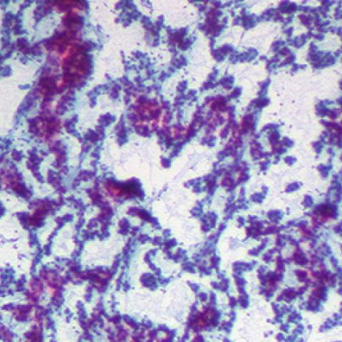 hepatocellular carcinoma