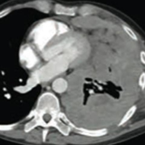 CT scan of a patient with mesothelioma