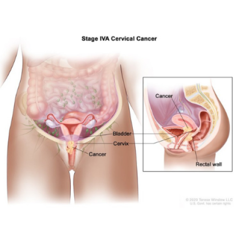 Cervical Cancer Stage IVA