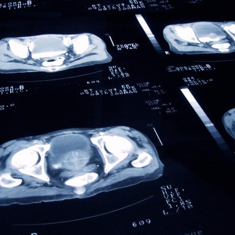 A series of images depicting computed tomography (CT) scans of prostate cancer.