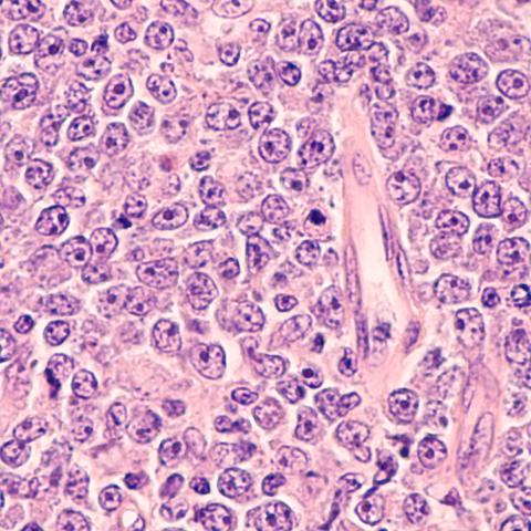 Photomicrograph of a diffuse large B-cell lymphoma 