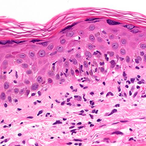 Cyclophosphamide works in an unexpected way to curb graft-vs-host ...