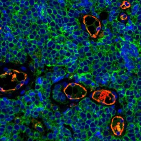 Merkel cell carcinoma cells