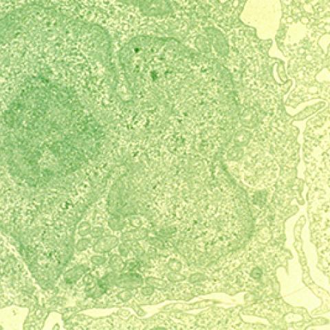 hairy cell leukemia