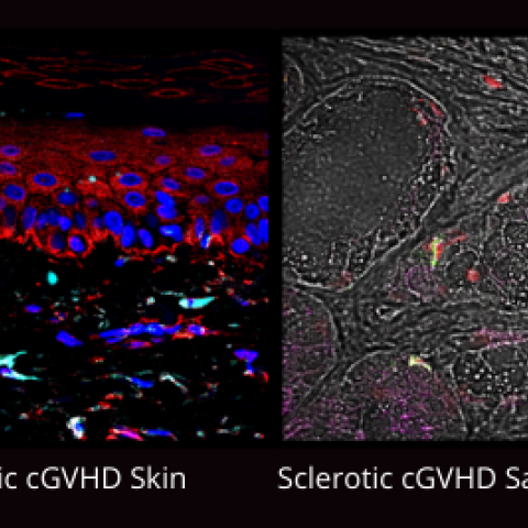 chronic GVHD sclerotic skin and salivary gland