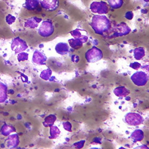 Large B-cell lymphoma